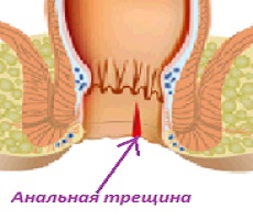 Анальная трещина